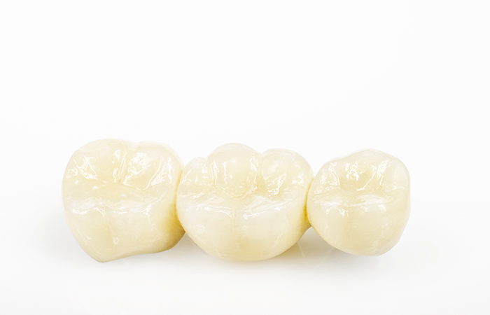 ハイブリッドの詰め物・被せ物