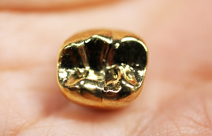 ゴールドの詰め物・被せ物