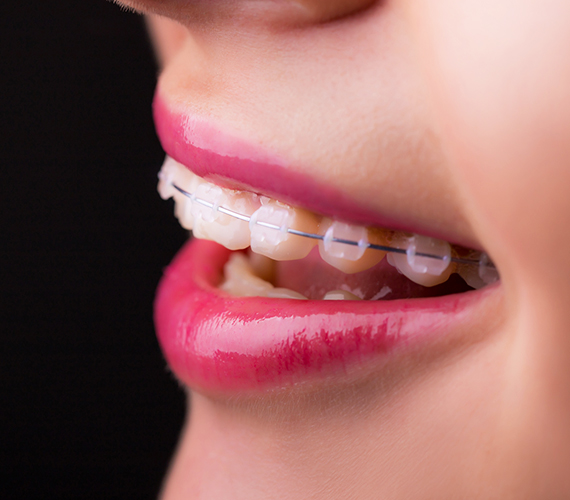 矯正歯科・小児矯正歯科